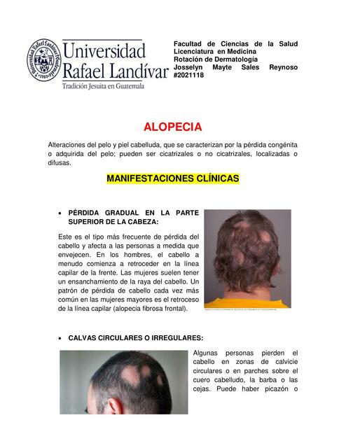 Alopecia