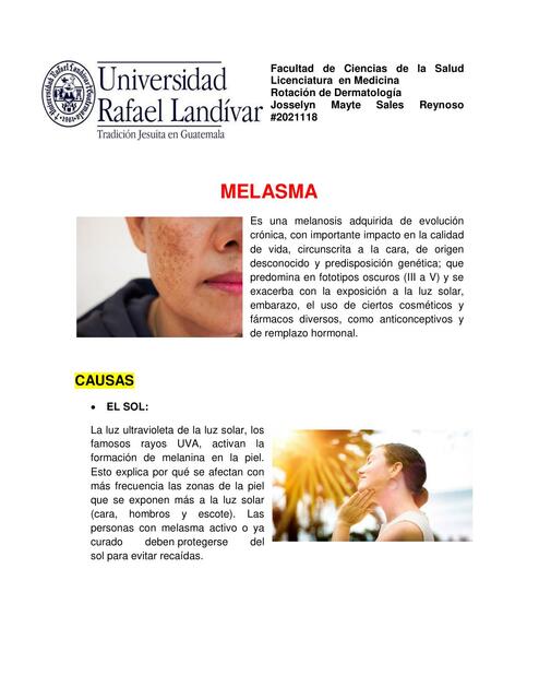 Melasma 