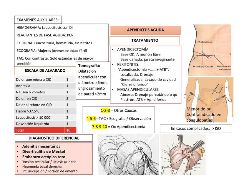 Apendicitis