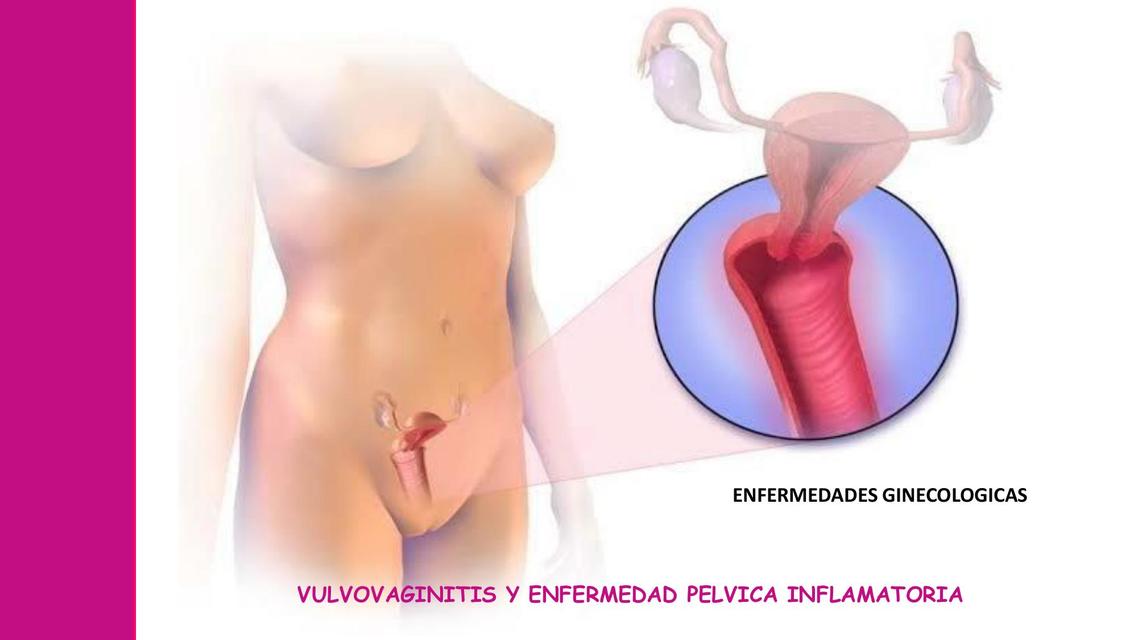 VULVOVAGINITIS Y EPI