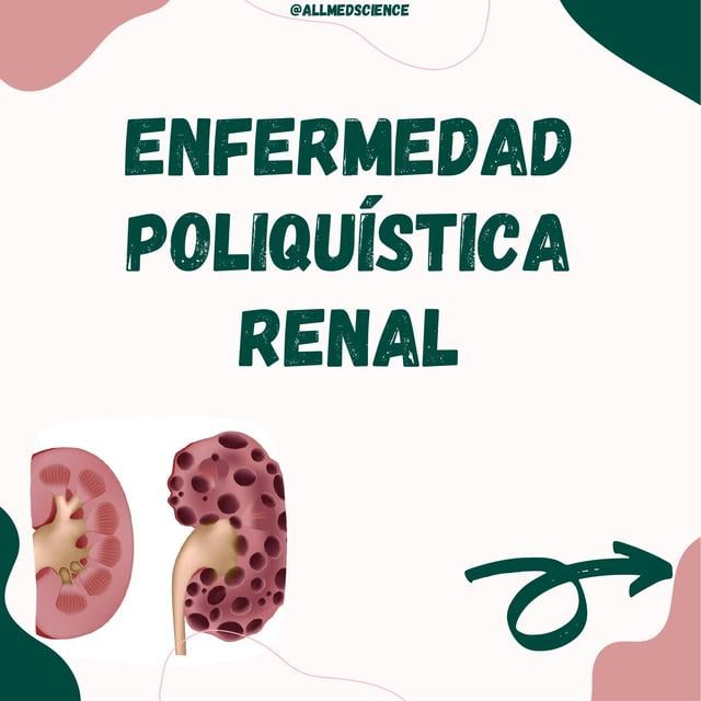 Enfermedad Poliqu stica Renal UDocz