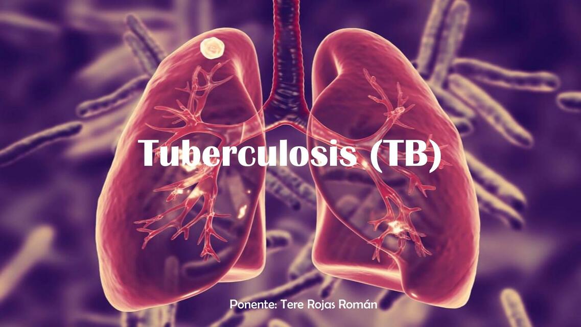 TUBERCULOSIS By  Tere Rojas Román