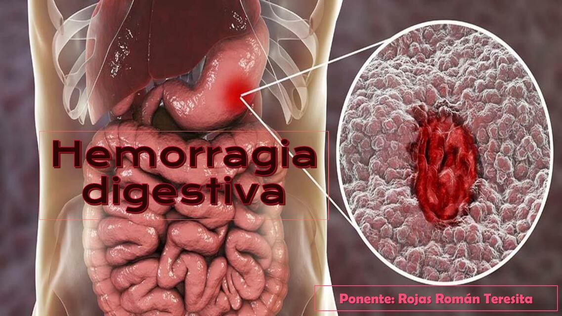 HEMORRAGIA DIGESTIVA by Rojas Román Teresita Autoguardado