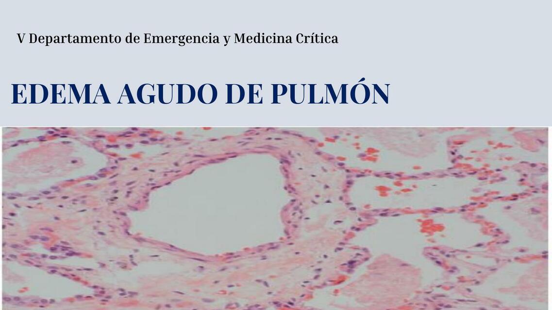 Edema Agudo de Pulmón