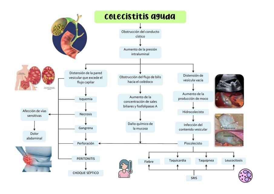 Colecistitis Aguda 