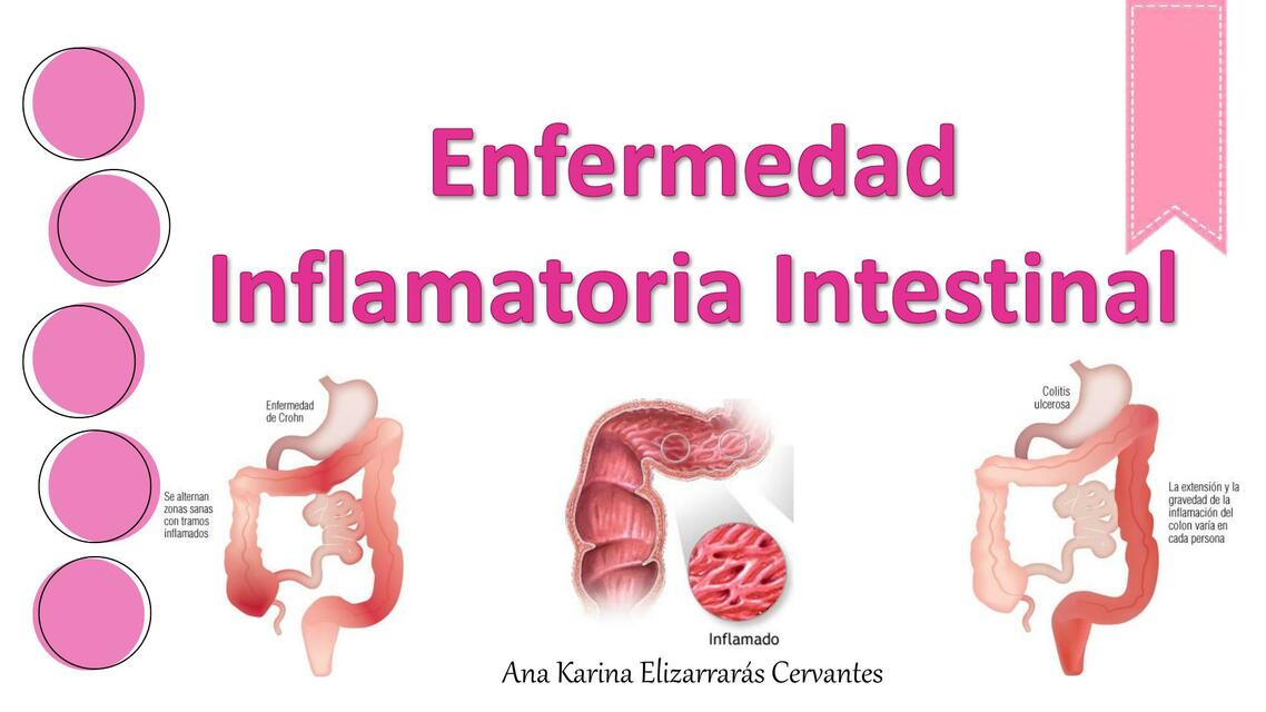 Enfermedad inflamatoria intestinal