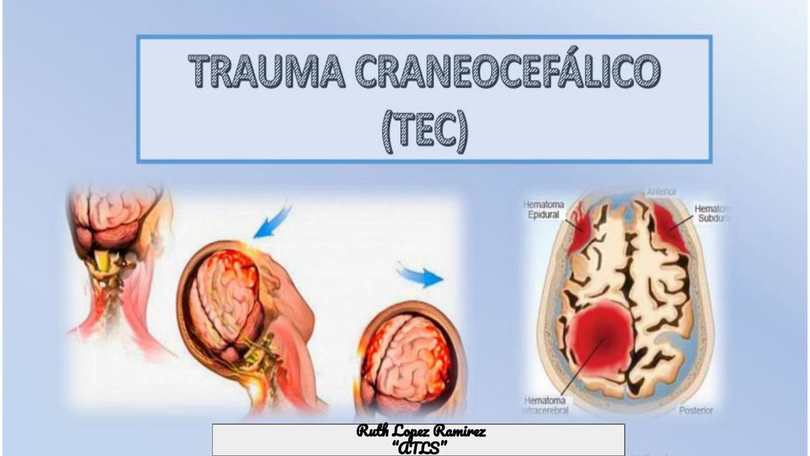 Trauma craneocefálico