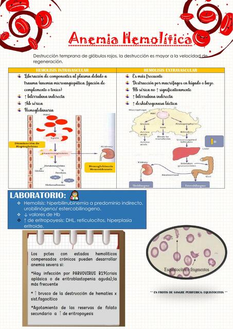 Anemia Hemolítica 