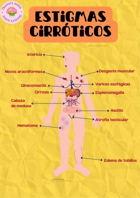 Estigmas Cirróticos