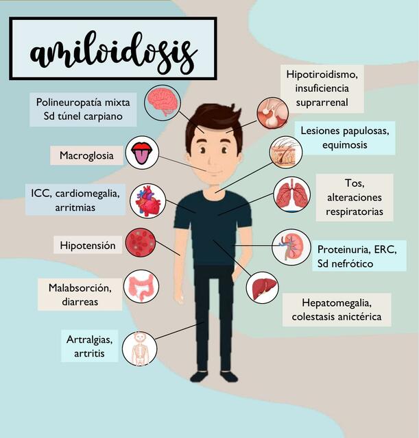 Amiloidosis Flavia Rodr guez Bracamonte UDocz