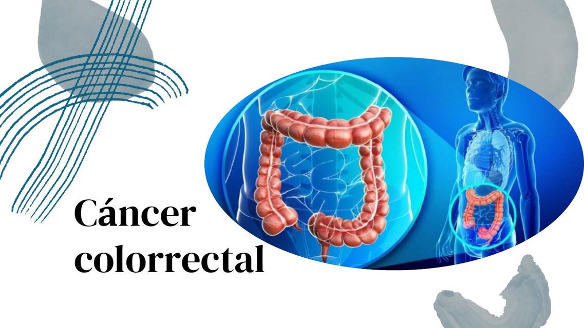 Cáncer de colon y recto