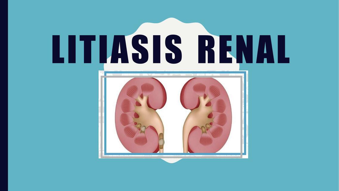 Litiasis Renal 