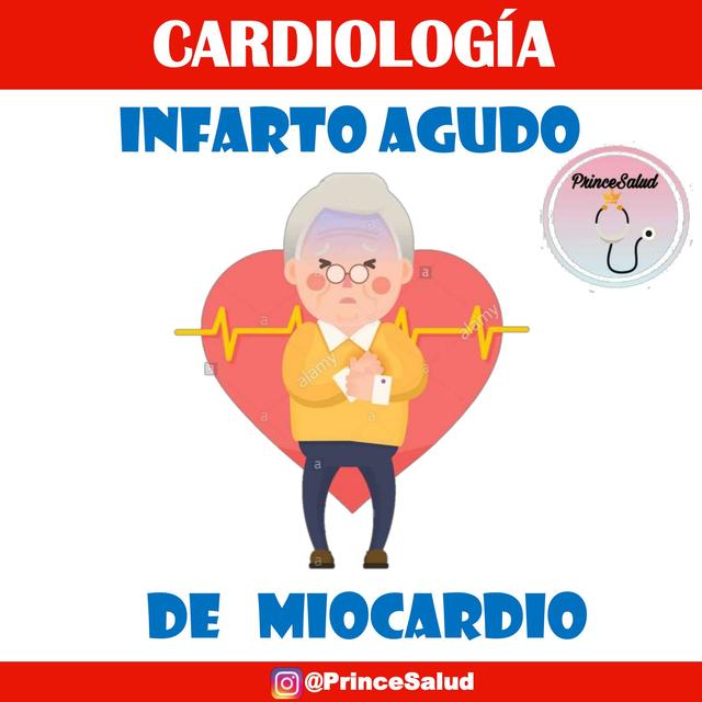 Infarto agudo de miocardio