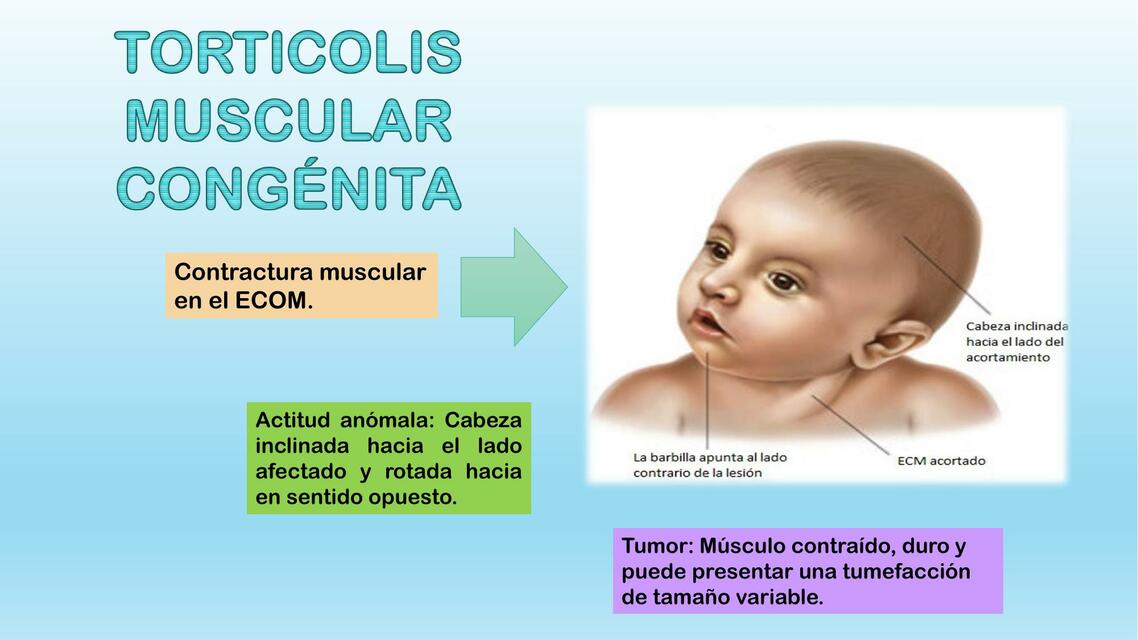 Torticolis Muscular Congénita 