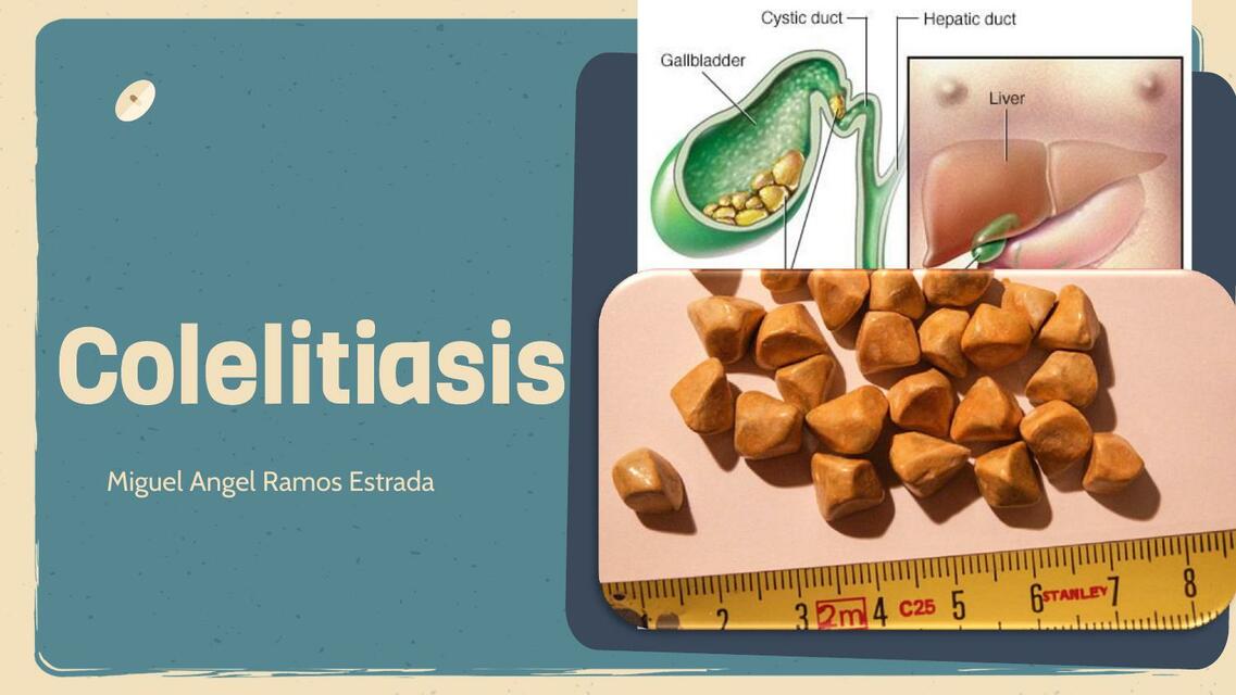 Colelitiasis