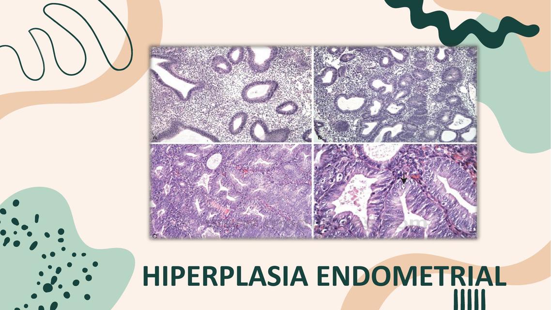 HIPERPLASIA ENDOMETRIAL