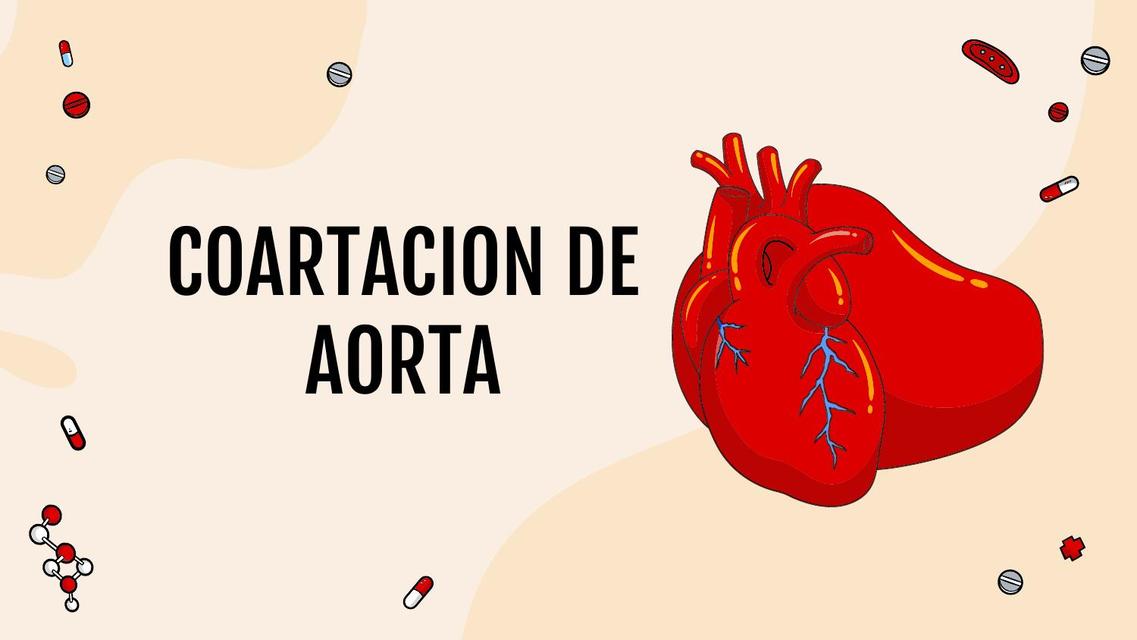 Coartación de Aorta 