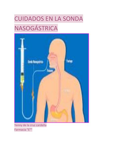 Cuidados en la Sonda Nasogástrica 