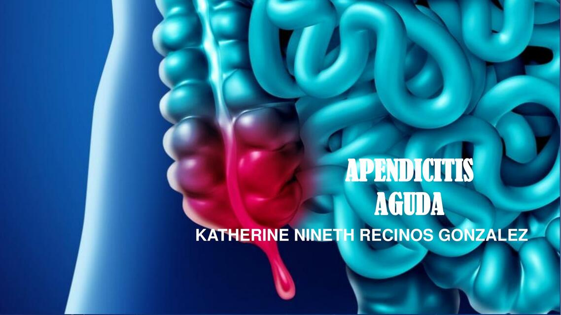 Apendicitis Aguda 