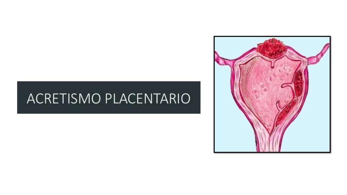 Acretismo Placentario