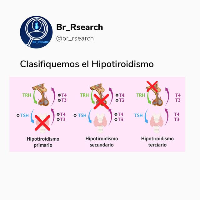 Hipotiroidismo