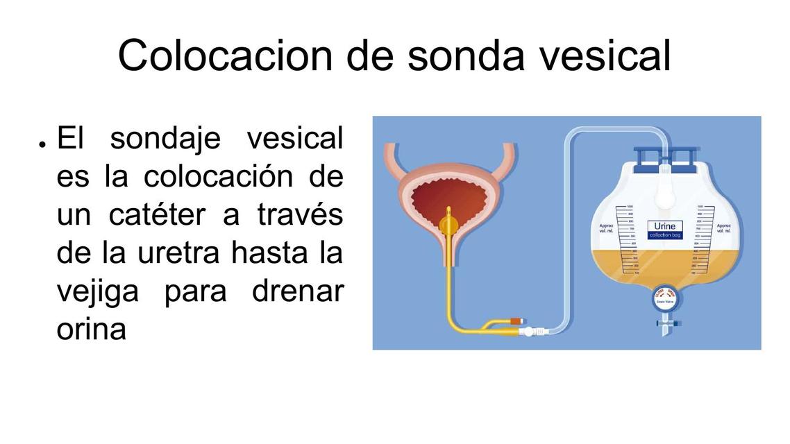 Sondaje Vesical