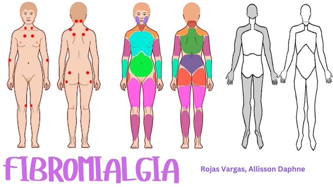 Fibromialgia 