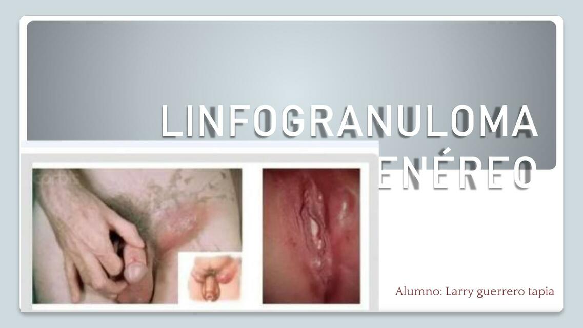 Linfogranuloma 