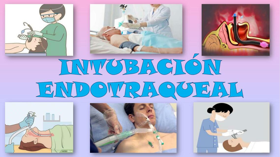 EXPOSICION ENDOTRAQUEAL 