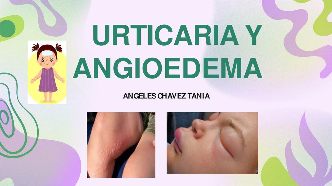 Urticaria y Angioedema 