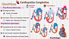 Cardiopatias Congenitas Cianoticas - Flujo pulmonar Aumentado y Disminuido 