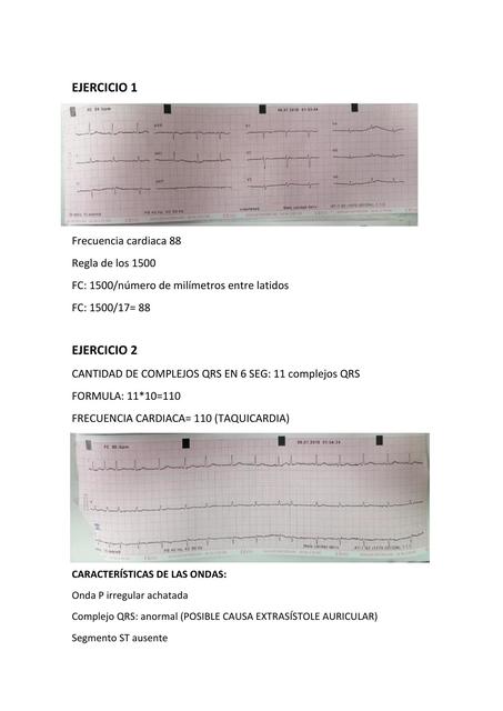 EJERCICIO de EKG