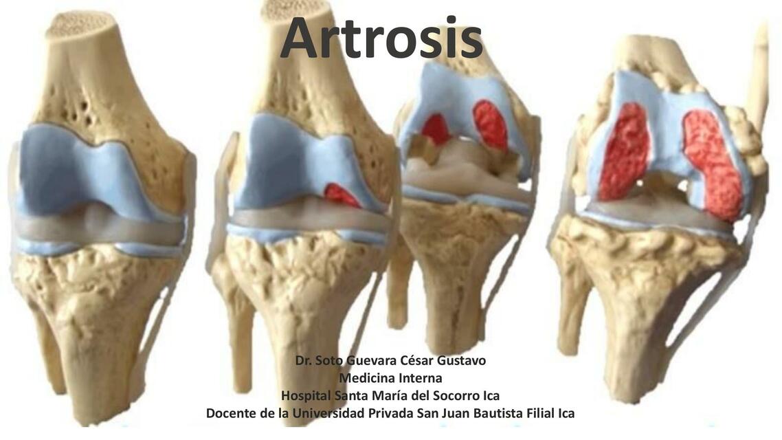 Artrosis