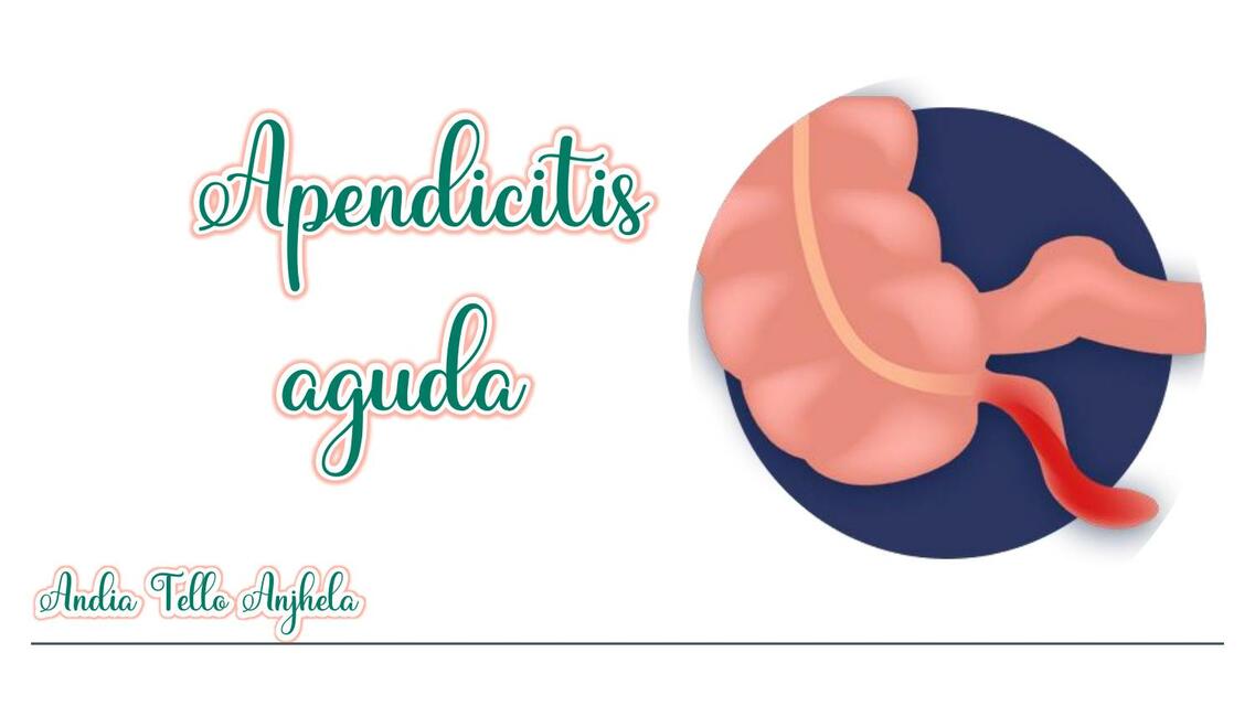 Apendicitis Aguda