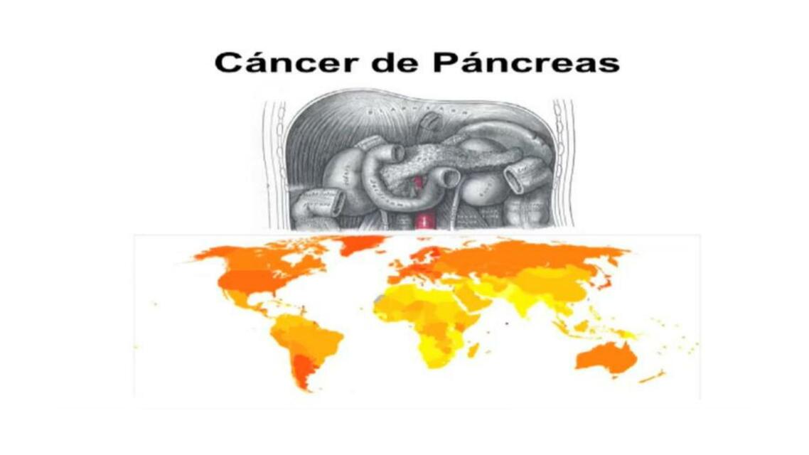 Cáncer de Páncreas 