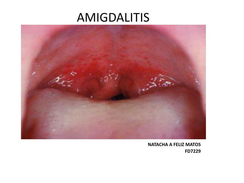 Amigdalitis y otitis Diiana Rafael uDocz
