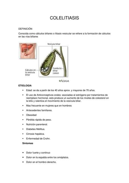 Colelitiasis