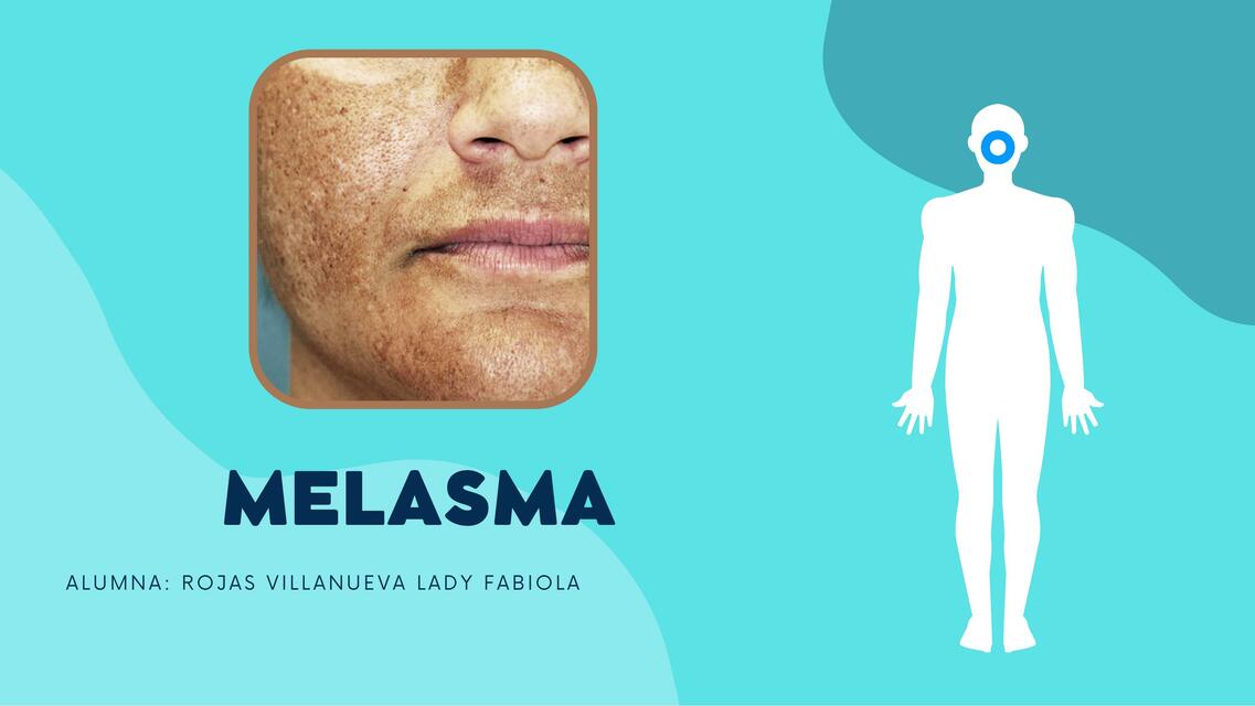 Melasma