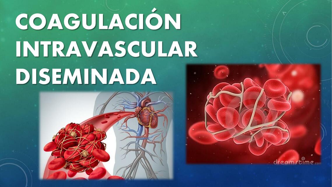 Coagulación intravascular diseminada