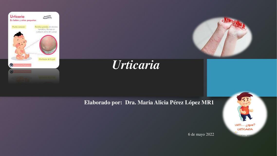 Urticaria