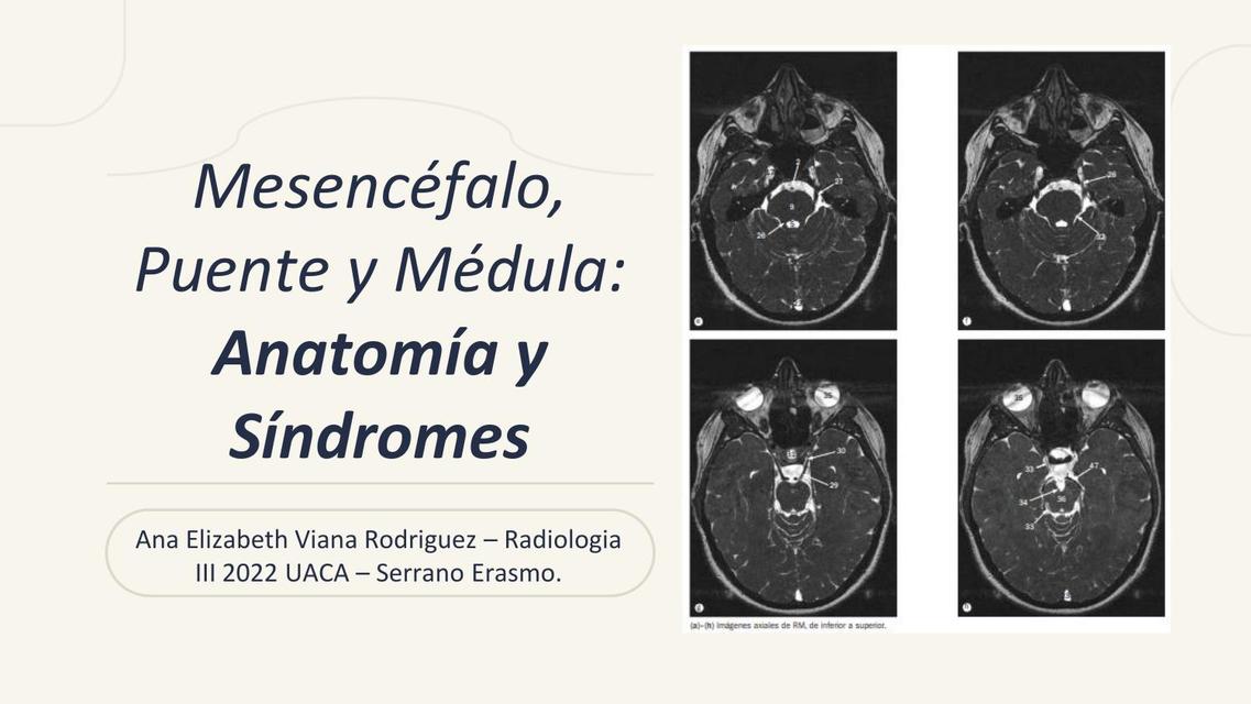 Mesencéfalo Puente y Médula - Síndromes