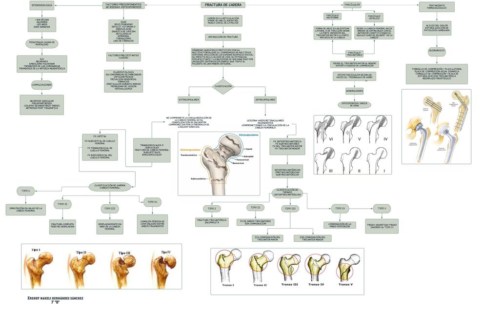 FRACTURA DE CADERA 