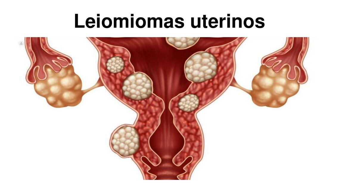 Leiomiomas uterinos