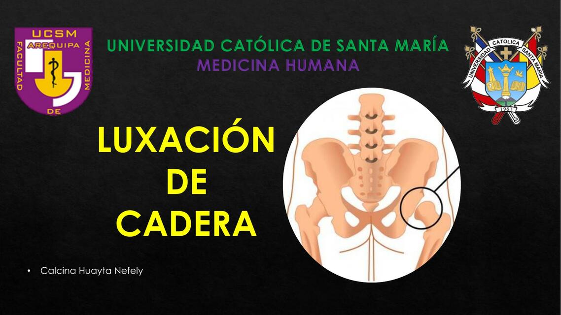 Luxación de cadera