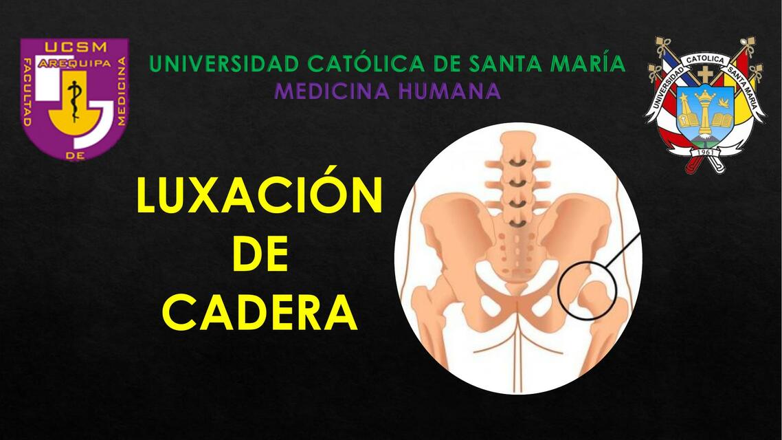 Luxación de Cadera 