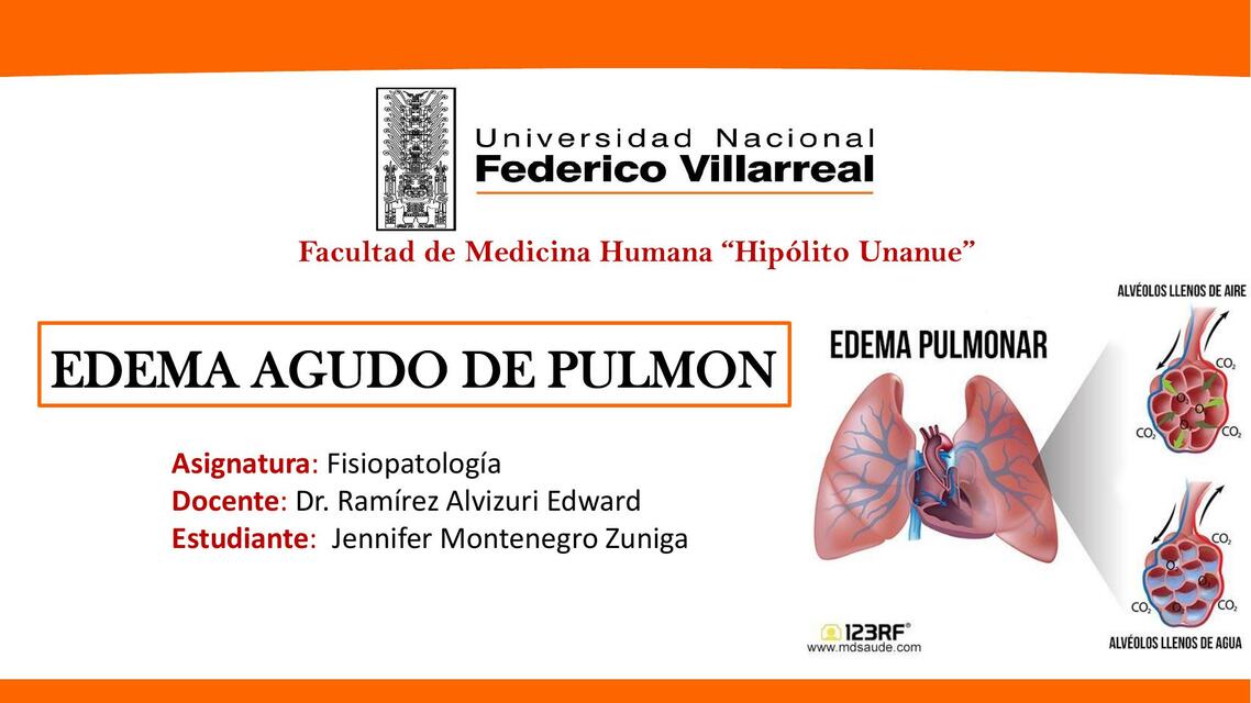 Edema Agudo de Pulmón 