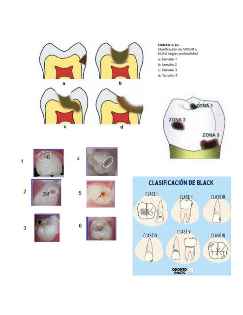 Clasificación de caries