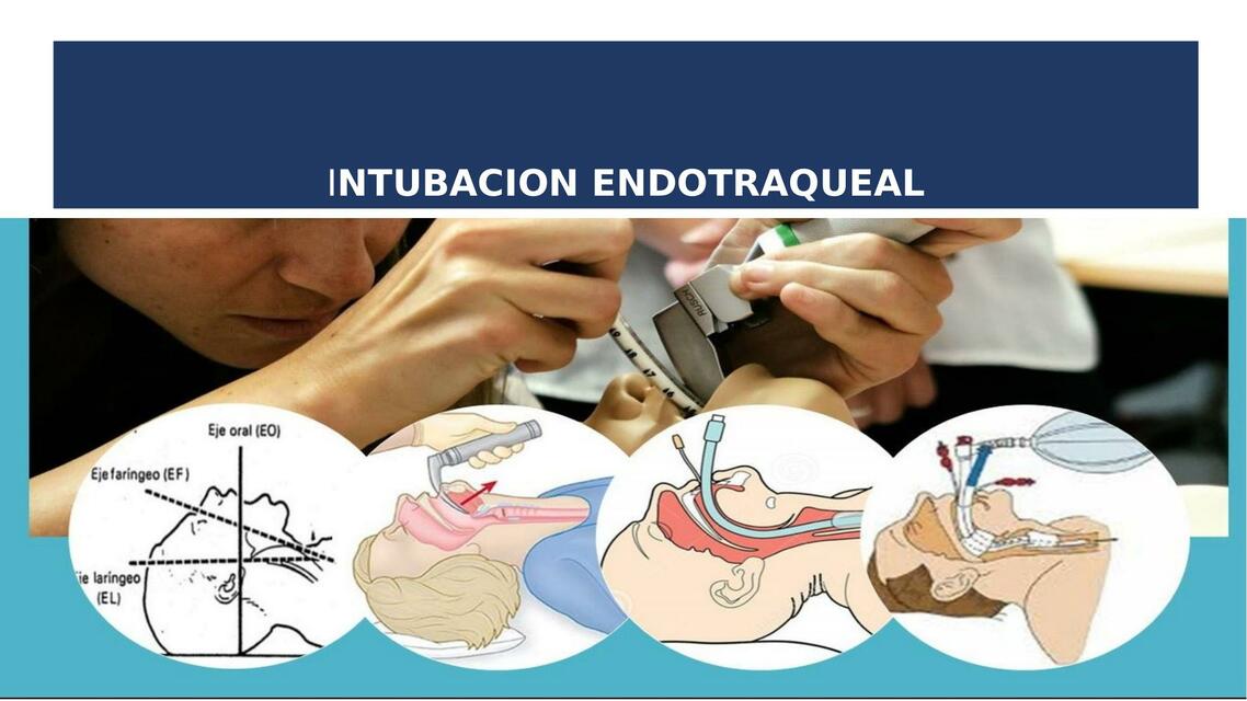 Intubación endotraqueal