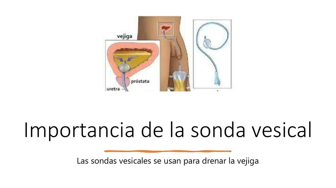 Importancia de la Sonda vesical