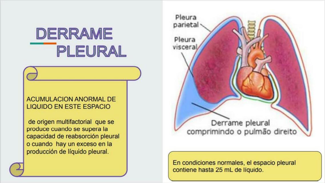 Derrame pleural 2